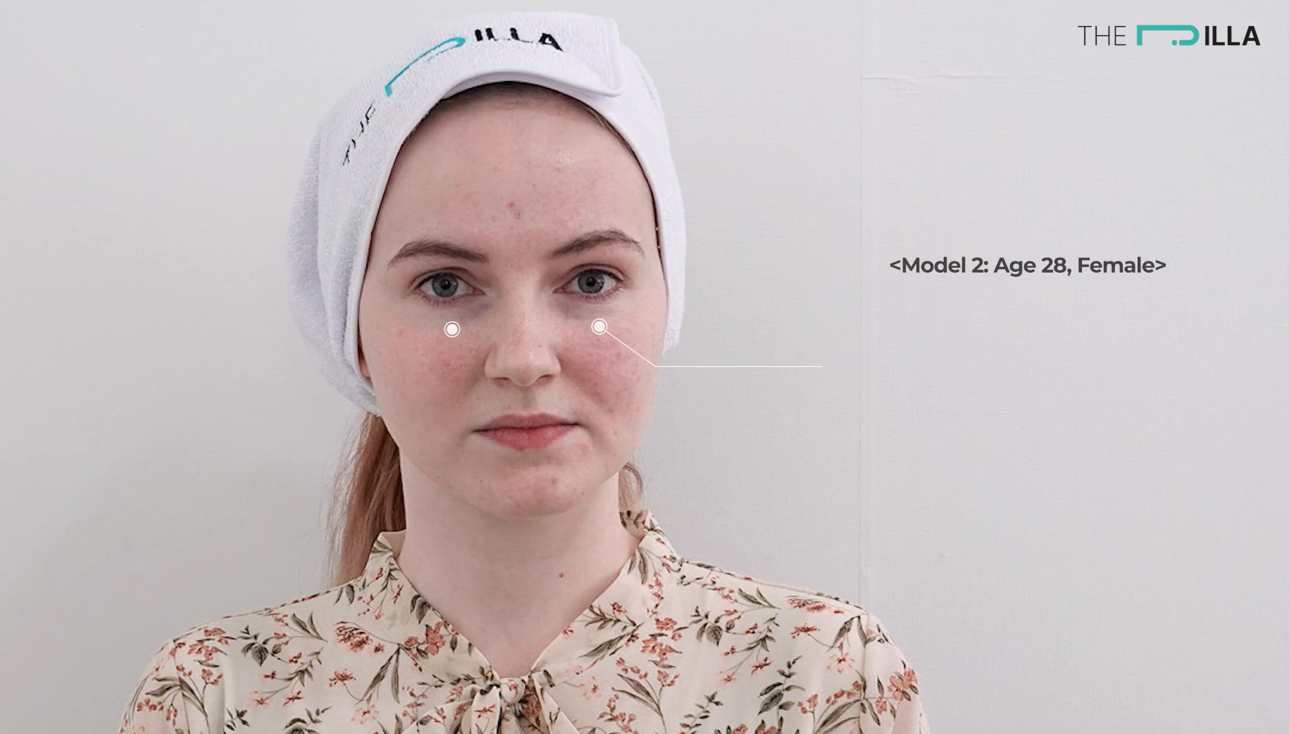 nasojugal fold - the pilla